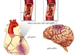 اقدامات اولیه در زمان حمله قلبی و سکته مغزی را بنویسید